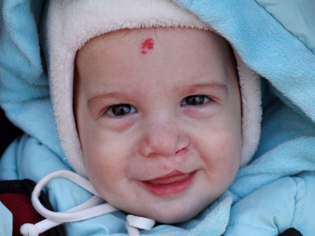 What Is the Cleft Lip Disability in Neonates