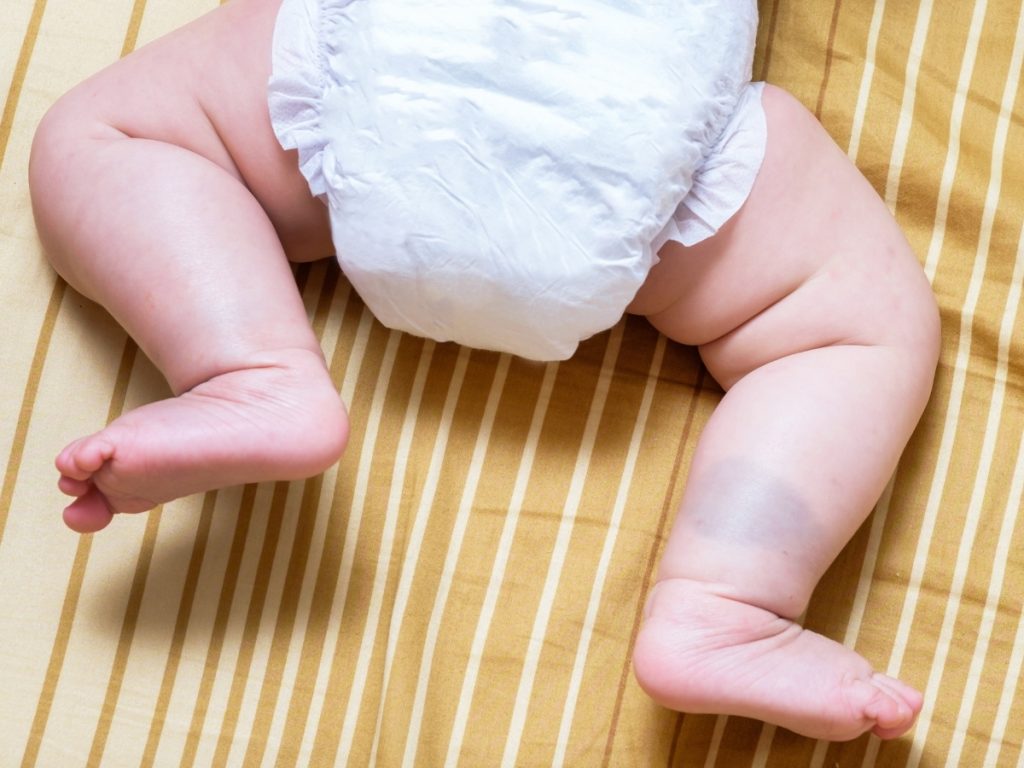 What Parents Should Know About Birthmark Treatment