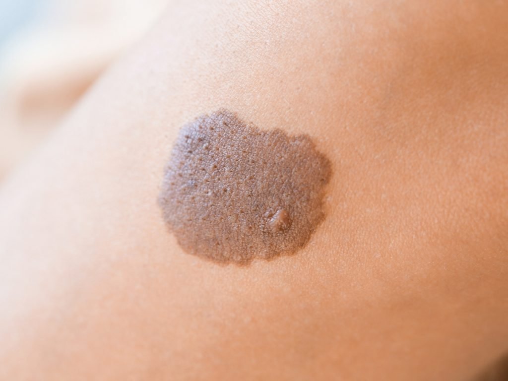 How to Choose the Best Birthmark Removal Treatments for Babies