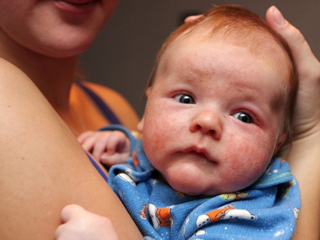 How to Cure and Prevent Eczema in Newborns and Infants