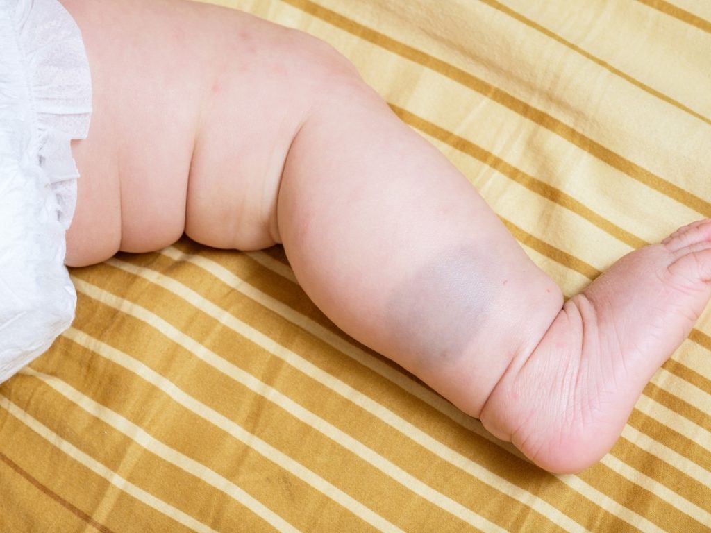 How to Remove Baby Cyan Birthmark Safely