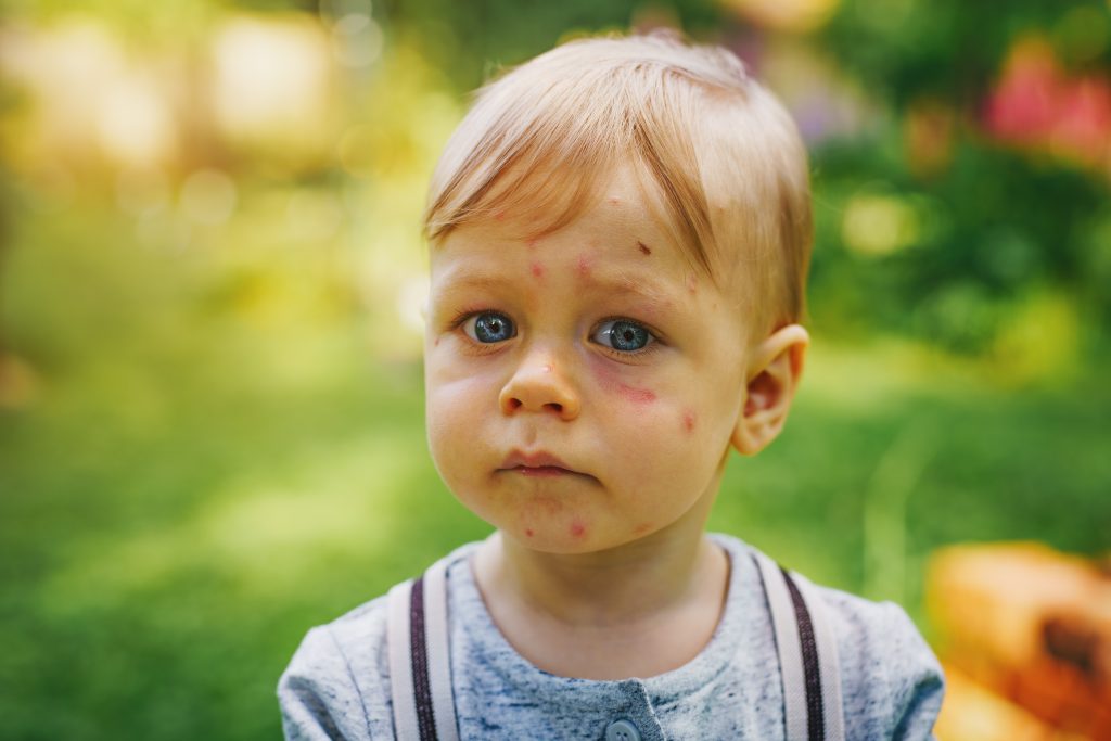 What Are Baby Birthmarks