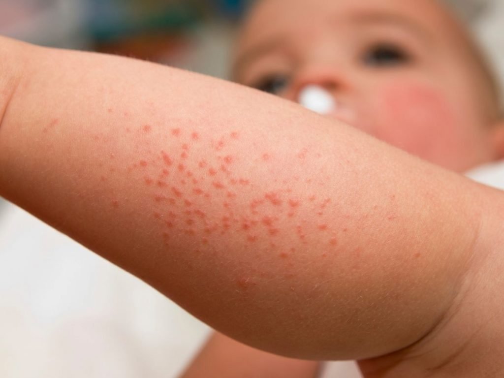 How to Effectively Treat an Infants Heat Rashes