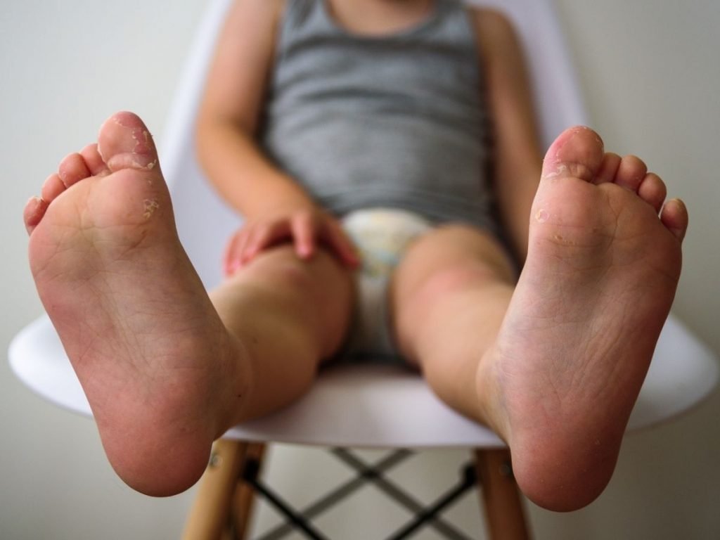 How to Heal Babys Cracked Skin Quickly