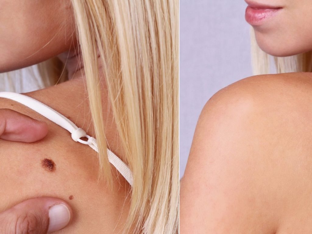 Should You Take Laser Therapy for Birthmark Removal