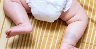 What Parents Should Know About Birthmark Treatment