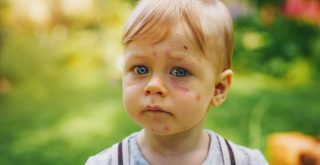 What Are Baby Birthmarks